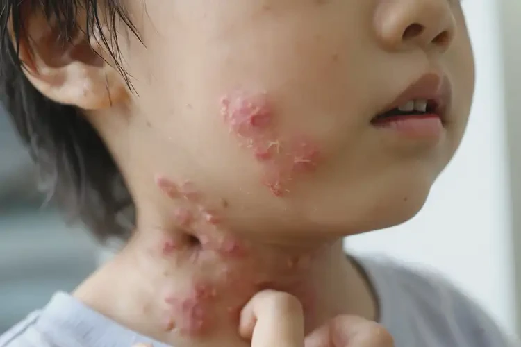 小孩脖子起濕疹能靠自己自愈嗎(圖4)