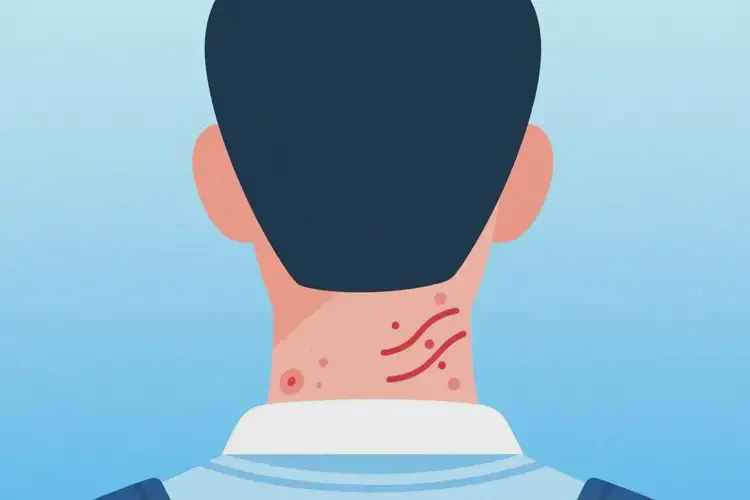 大學(xué)生脖子經(jīng)常起濕疹能徹底自愈嗎(圖3)