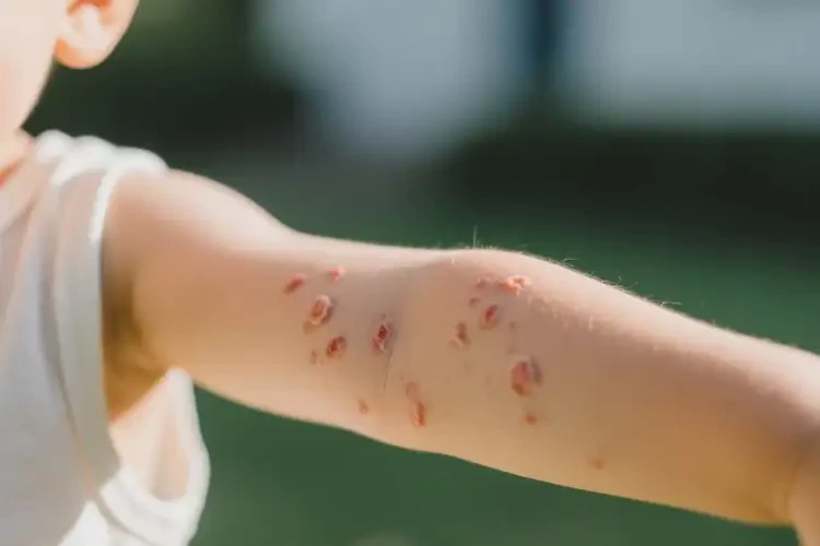 小兒手臂上經(jīng)常長濕疹能靠自己自愈嗎(圖4)