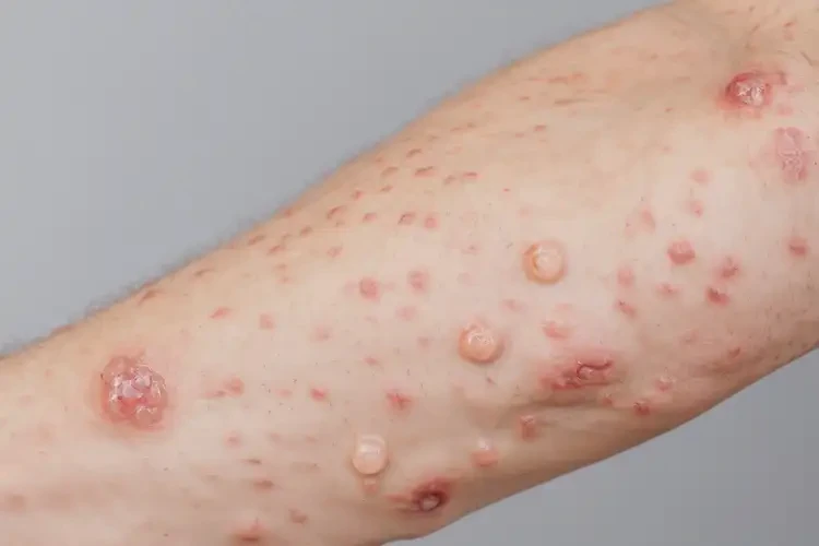 青年人身上有濕疹能夠徹底治愈嗎(圖4)