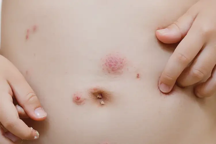 兒童肚子經(jīng)常起濕疹不管它會自己好嗎(圖3)