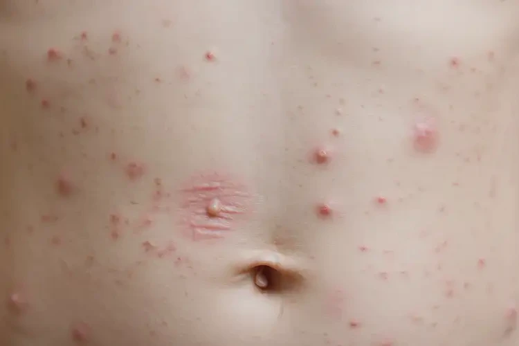 兒童肚子上起濕疹不管它會自己自愈嗎(圖4)