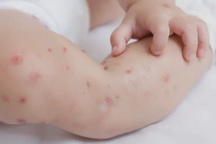 嬰幼兒小腿偶爾長濕疹可以徹底自愈嗎(圖4)