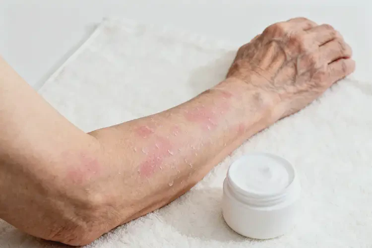 老人手臂偶爾起濕疹不管它會自己好嗎(圖1)