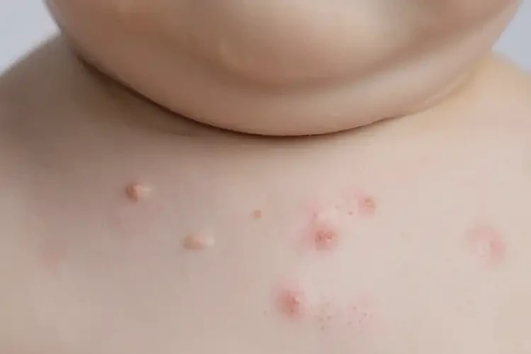 幼兒脖子上容易起濕疹不管它會自己痊愈嗎(圖4)