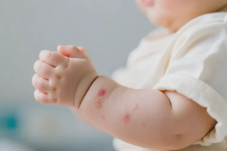 嬰兒手臂容易長(zhǎng)濕疹不管它會(huì)自己自愈嗎(圖3)