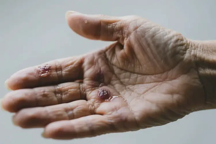 老人手上容易長濕疹不管它會自己痊愈嗎(圖3)