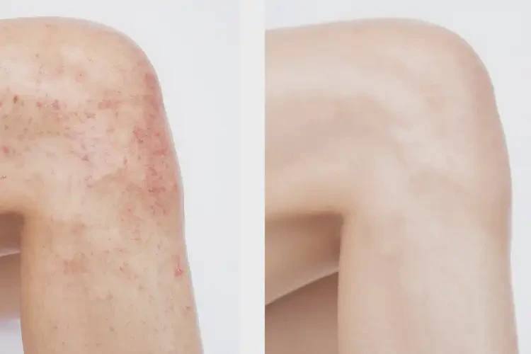 哺乳期媽媽小腿上長(zhǎng)濕疹不管它會(huì)自己自愈嗎(圖2)