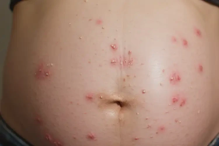 孕婦肚子上經(jīng)常起濕疹不管它會自己痊愈嗎(圖4)