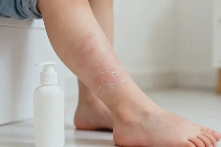 小孩小腿上出現(xiàn)濕疹不管它會自己痊愈嗎(圖1)