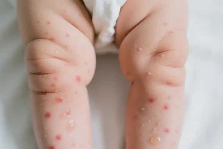 嬰兒大腿上出濕疹可以徹底自愈嗎(圖2)