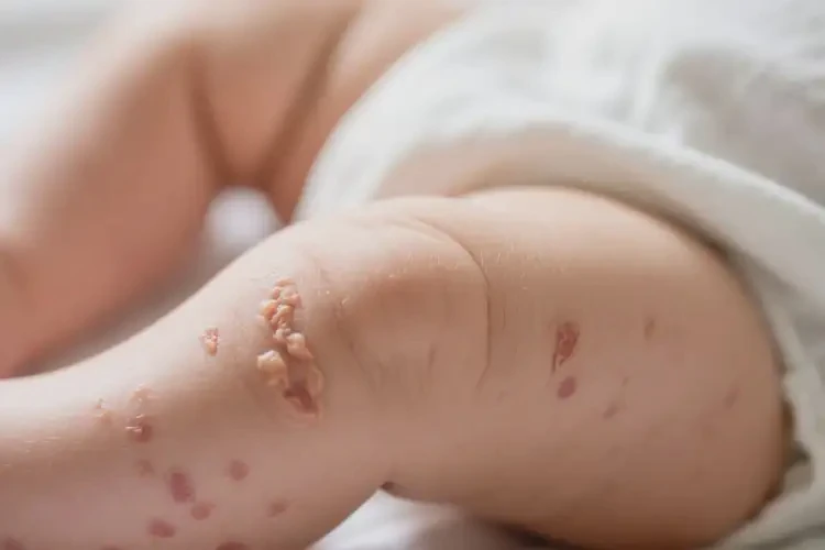 婴儿大腿上容易长湿疹不管它会自己痊愈吗(图4)