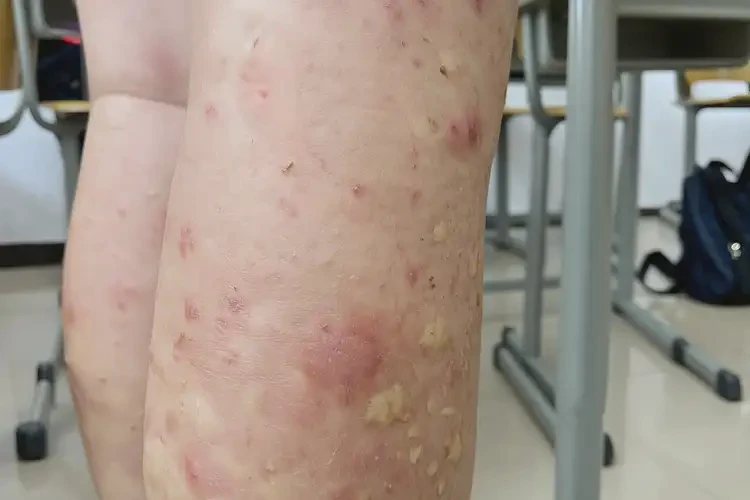 中學(xué)生小腿出濕疹不管它會自己好嗎(圖2)