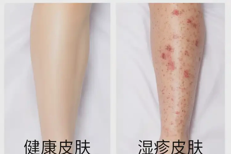 女生大腿上容易长湿疹能够彻底治愈吗(图2)