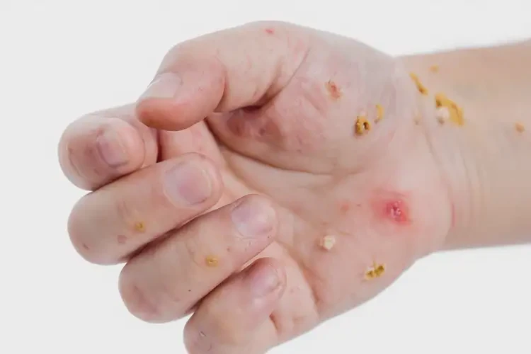 小孩手上長濕疹不管它會自己痊愈嗎(圖2)