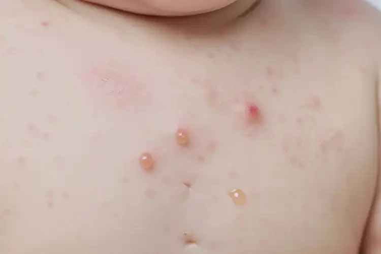 寶寶脖子有濕疹不管它會自己痊愈嗎(圖4)