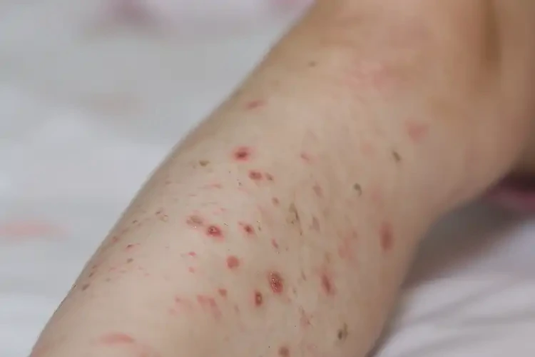 小孩小腿上起濕疹能靠自己自愈嗎(圖4)