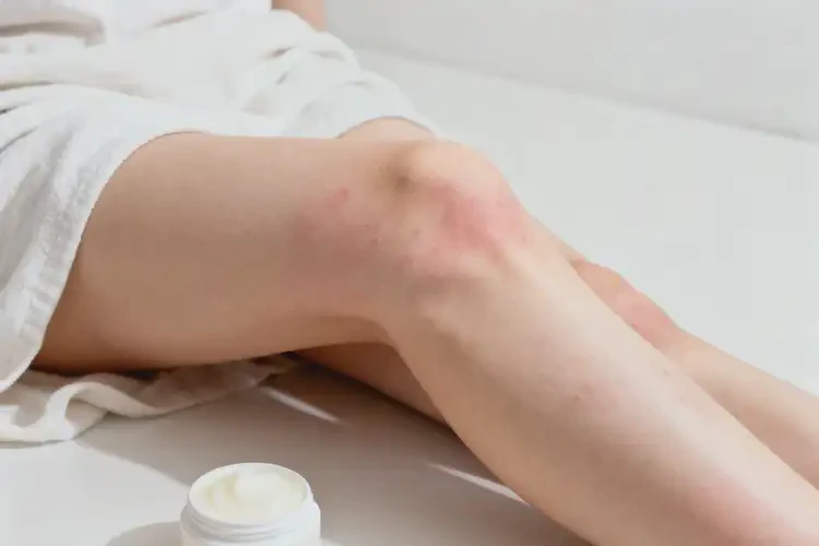 女生大腿偶爾起濕疹不管它會自己自愈嗎(圖4)