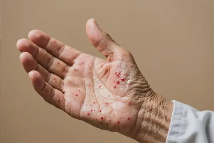 老人手上容易長濕疹不管它會自己痊愈嗎(圖2)