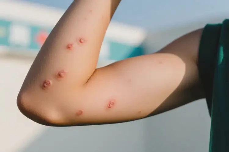 青少年手臂上偶爾起濕疹能靠自己自愈嗎(圖4)