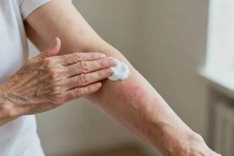 老年人手臂偶爾起濕疹不管它會(huì)自己自愈嗎(圖2)