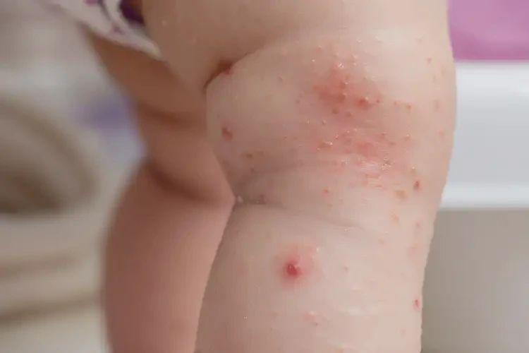 小孩小腿上起濕疹能靠自己自愈嗎(圖3)