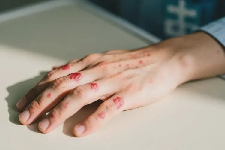 青年人手上出现湿疹不管它会自己好吗(图3)