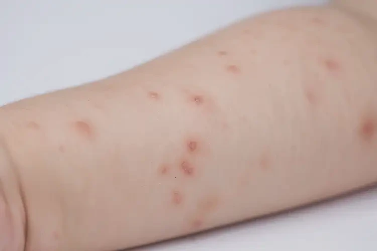 小孩手臂上容易起濕疹可不可以徹底自愈(圖4)
