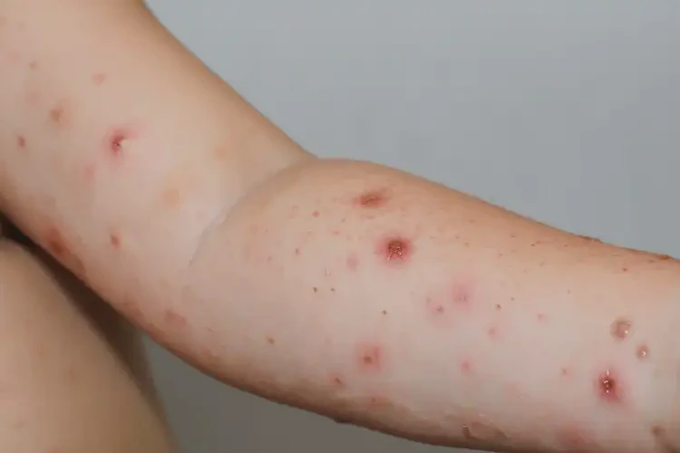 小孩手臂出現(xiàn)濕疹能徹底自愈嗎(圖4)