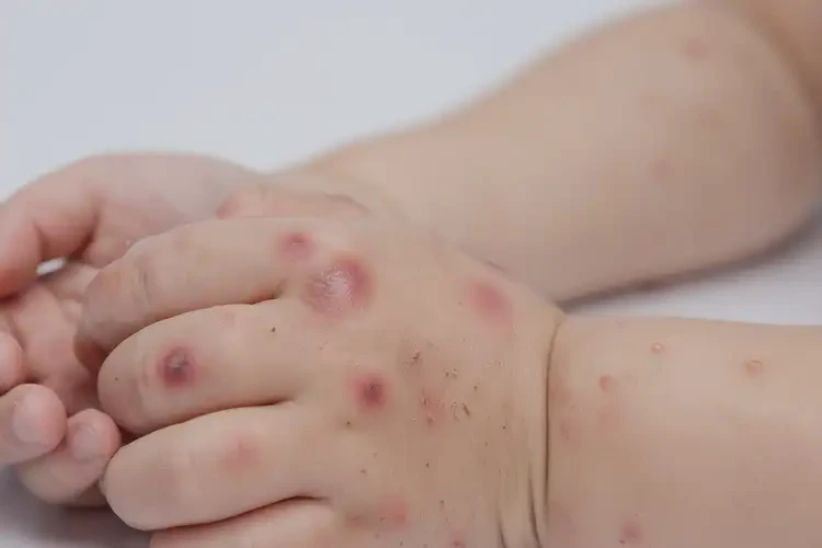 孩子手上出现湿疹能够彻底治愈吗(图4)