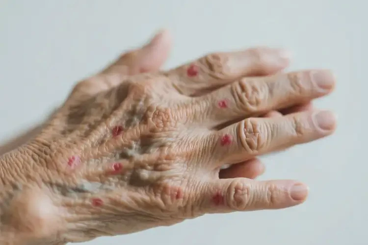 老人手上偶爾起濕疹不管它會(huì)自己好嗎(圖4)