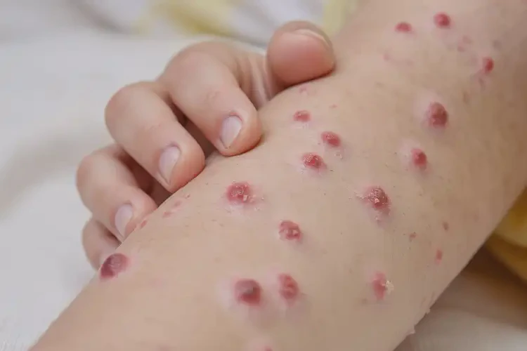 少兒身上起濕疹不管它會自己好嗎(圖4)