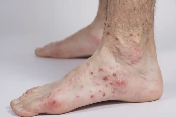 男生腳上起濕疹不管它會(huì)自己自愈嗎(圖4)