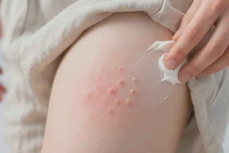 中學生大腿容易長濕疹能靠自己自愈嗎(圖4)