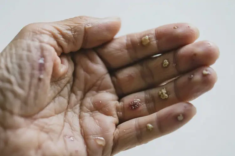 老人手上長濕疹不管它會自己好嗎(圖1)