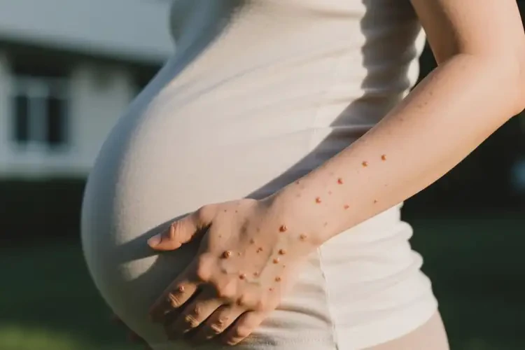 孕婦手上容易起濕疹不管它會自己自愈嗎(圖2)