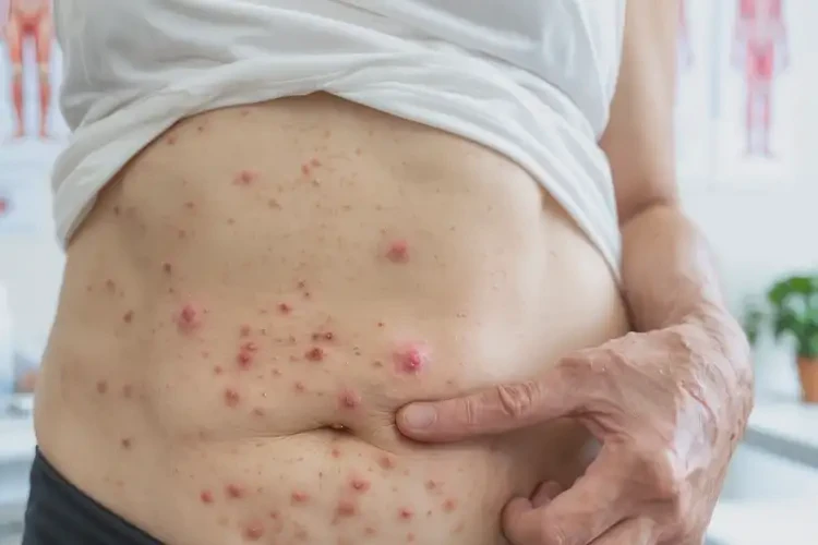 女生肚子偶尔起湿疹不管它会自己好吗(图4)