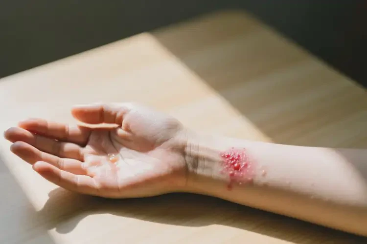 女性手臂上偶爾長濕疹不管它會自己自愈嗎(圖4)