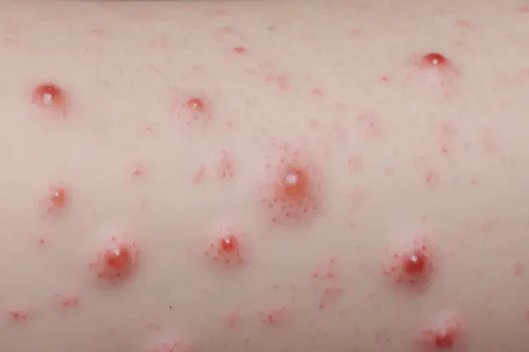 宝宝肛周起湿疹可不可以彻底自愈(图4)