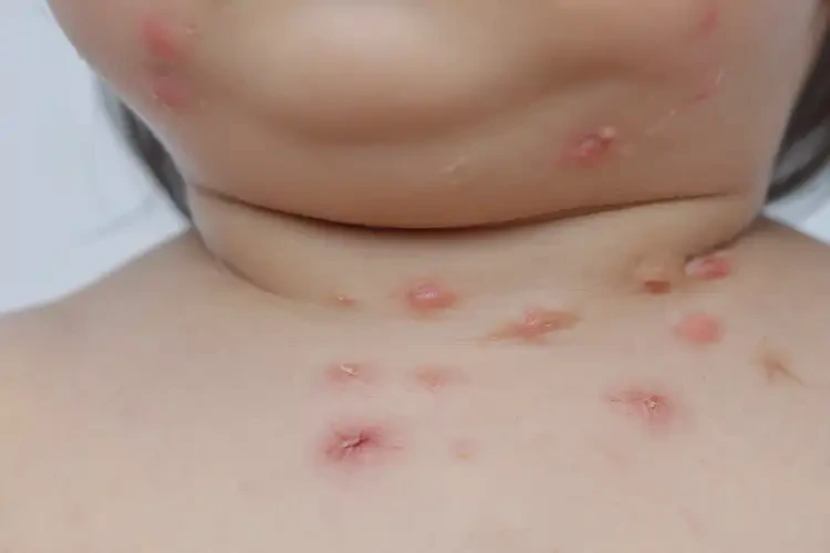 幼兒脖子出濕疹能徹底自愈嗎(圖4)