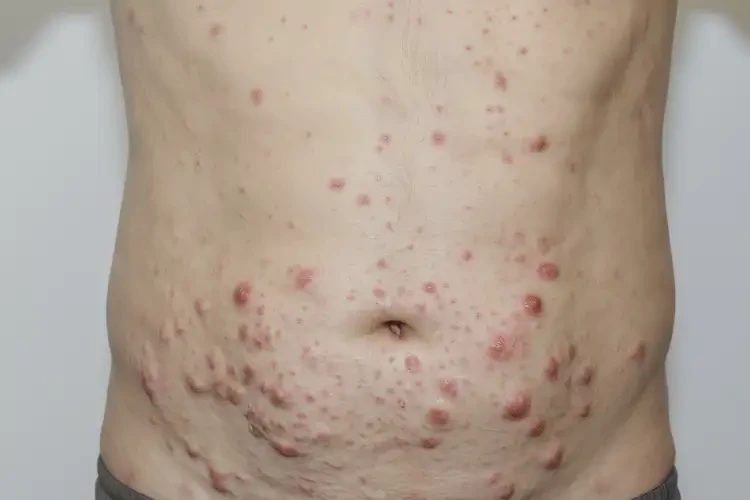 男生肚子出濕疹能靠自己自愈嗎(圖3)