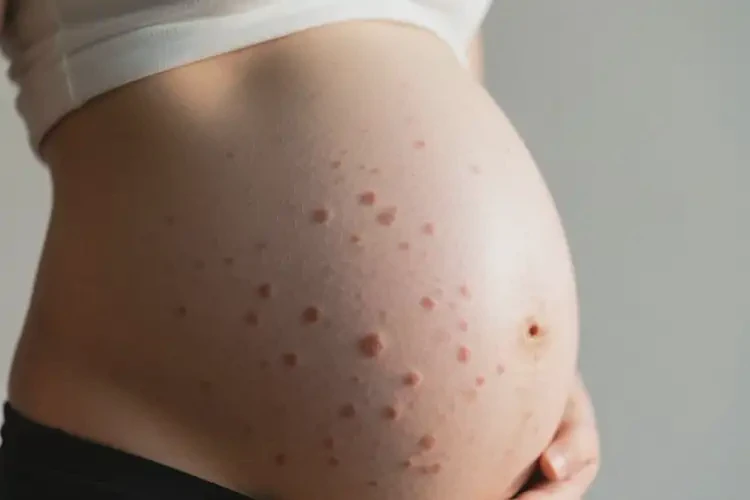 產(chǎn)婦肚子偶爾起濕疹不管它會自己自愈嗎(圖4)