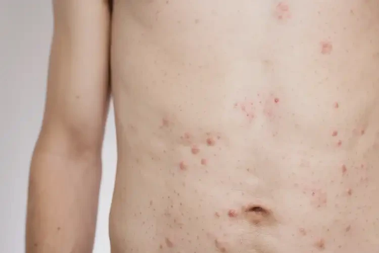 男生肚子出濕疹能靠自己自愈嗎(圖4)