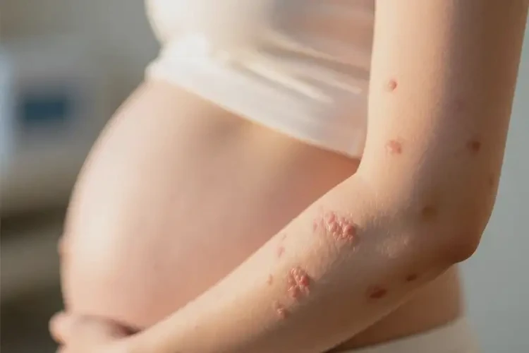 產(chǎn)婦手臂容易起濕疹可以徹底自愈嗎(圖4)