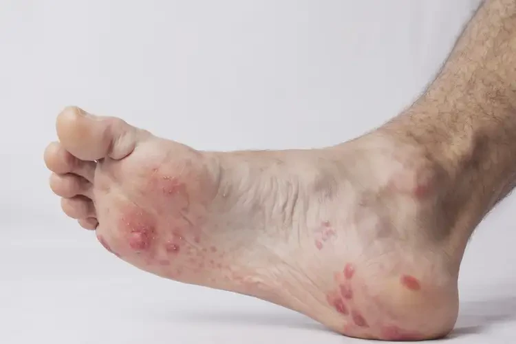 小孩腳上起濕疹不管它會自己好嗎(圖3)