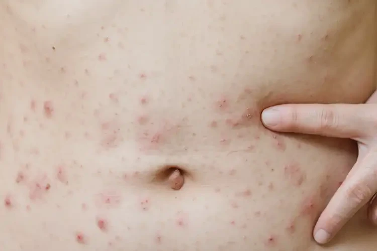 女人肚子上偶爾起濕疹不管它會(huì)自己痊愈嗎(圖4)