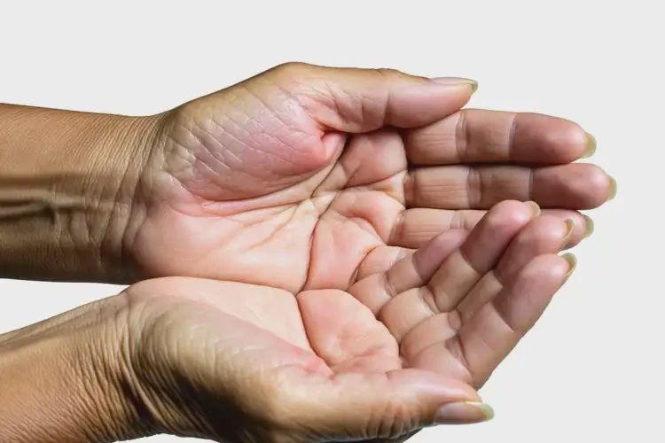 高齡老人手上出現(xiàn)濕疹不管它會(huì)自己自愈嗎(圖3)