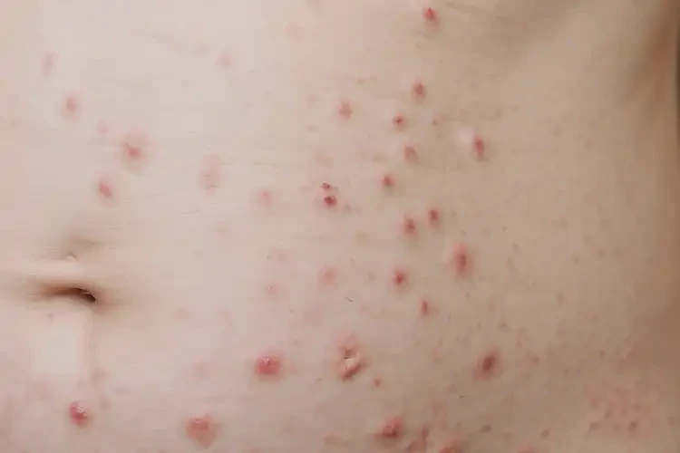 產(chǎn)婦屁股上出濕疹不管它會自己自愈嗎(圖4)