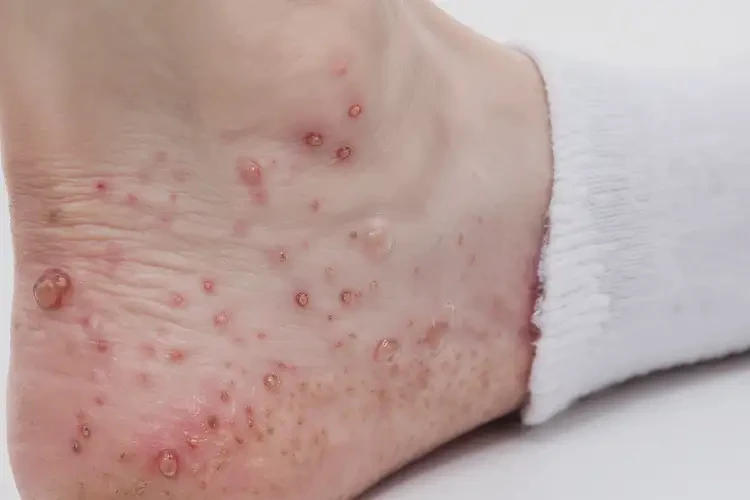 大學(xué)生腳上起濕疹不管它會(huì)自己痊愈嗎(圖4)