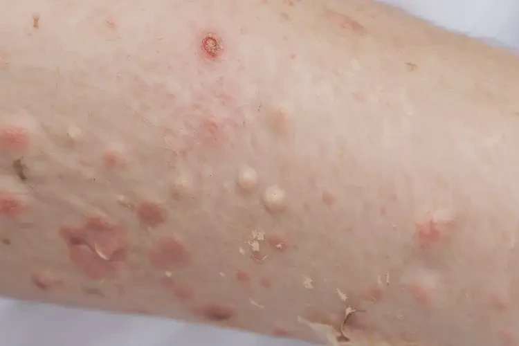 兒童身上出濕疹能徹底自愈嗎(圖4)